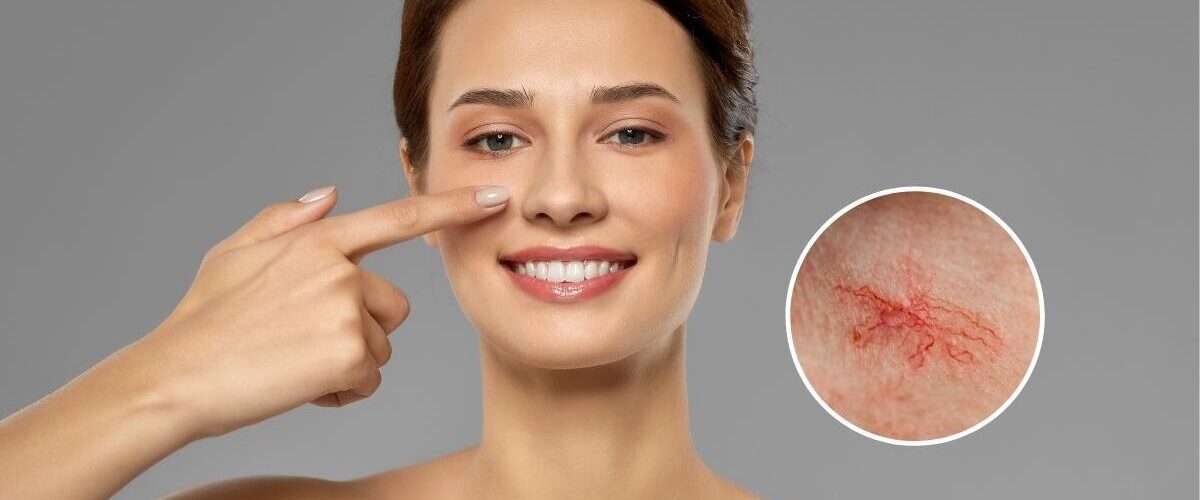 Causes Of Facial Spider Veins